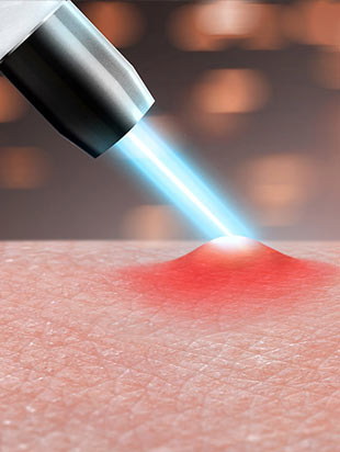 laserowe leczenie trądziku