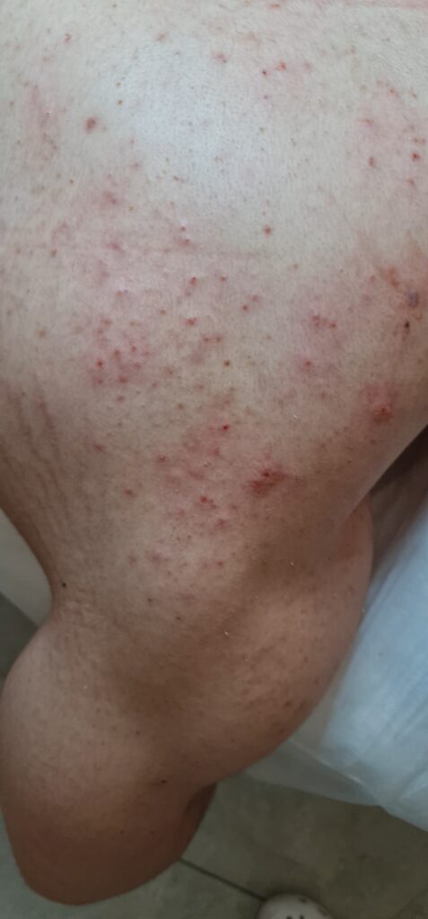 oczyszczanie pleców, oczyszczanie manualne skóry pleców, trądzik na plecach