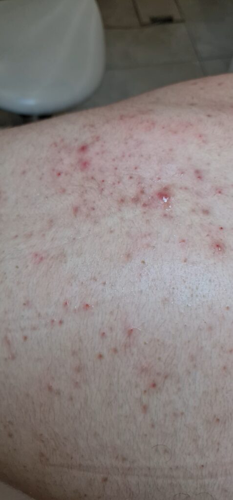 trądzik na plecach, pryszcze, oczyszcczanie pleców, oczyszczanie manualne, zabieg na skóre pleców