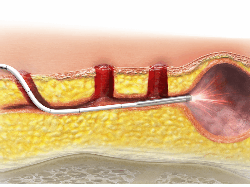 laserowe leczenie torbieli pilonidalnej, torbieli włosowej