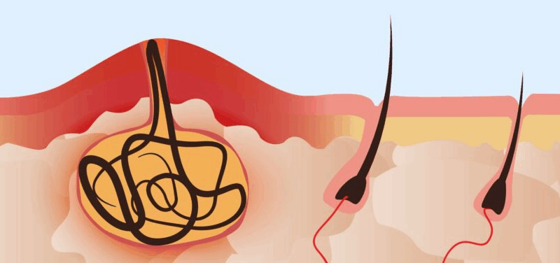 wrastające włosy torbiel pilonidalna
