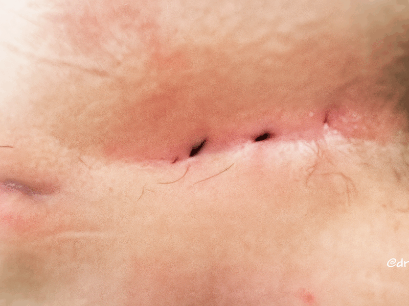 torbiel włosowa, torbiel pilonidalna, ropień pilonidalnny, depilacja laserowa w torbieli pilonidalnej