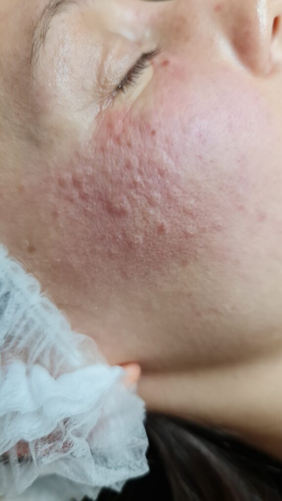 trądzik, usuwanie trądziku trądzik dorosłych